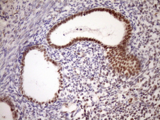 WTAP Antibody - IHC of paraffin-embedded Carcinoma of Human pancreas tissue using anti-WTAP mouse monoclonal antibody. (Heat-induced epitope retrieval by Tris-EDTA, pH8.0)(1:150).