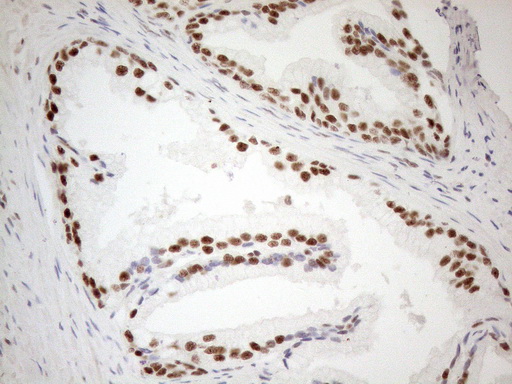 WTAP Antibody - Immunohistochemical staining of paraffin-embedded Human prostate tissue using anti-WTAP mouse monoclonal antibody. (Heat-induced epitope retrieval by 1mM EDTA in 10mM Tris buffer. (pH8.5) at 120°C for 3 min. (1:150)