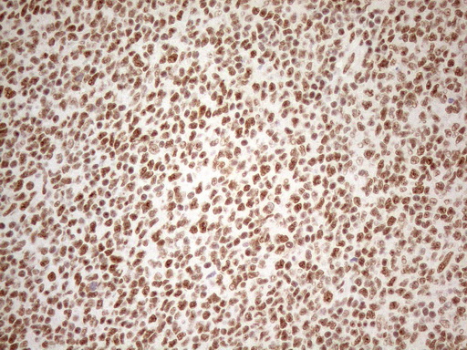 WTAP Antibody - Immunohistochemical staining of paraffin-embedded Human lymphoma tissue using anti-WTAP mouse monoclonal antibody. (Heat-induced epitope retrieval by 1mM EDTA in 10mM Tris buffer. (pH8.5) at 120°C for 3 min. (1:150)