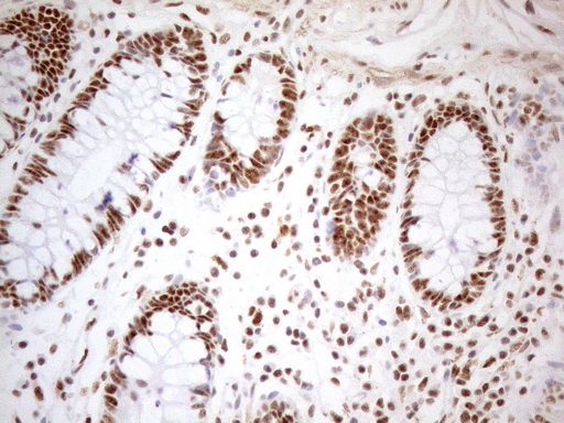 WTAP Antibody - Immunohistochemical staining of paraffin-embedded Human colon tissue using anti-WTAP mouse monoclonal antibody. (Heat-induced epitope retrieval by 1mM EDTA in 10mM Tris buffer. (pH8.5) at 120°C for 3 min. (1:150)