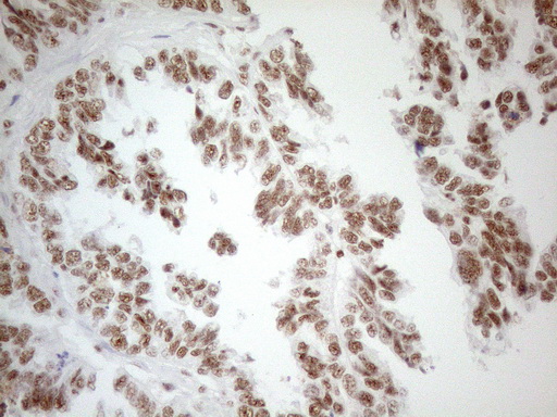 WTAP Antibody - Immunohistochemical staining of paraffin-embedded Adenocarcinoma of Human ovary tissue using anti-WTAP mouse monoclonal antibody. (Heat-induced epitope retrieval by 1mM EDTA in 10mM Tris buffer. (pH8.5) at 120°C for 3 min. (1:150)