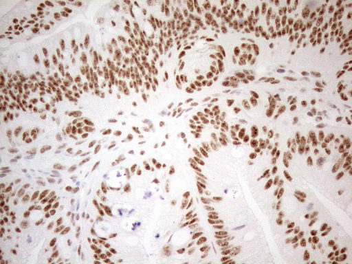 WTAP Antibody - Immunohistochemical staining of paraffin-embedded Carcinoma of Human pancreas tissue using anti-WTAP mouse monoclonal antibody. (Heat-induced epitope retrieval by 1mM EDTA in 10mM Tris buffer. (pH8.5) at 120°C for 3 min. (1:150)