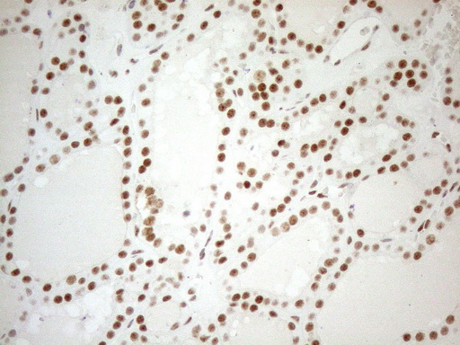 WTAP Antibody - Immunohistochemical staining of paraffin-embedded Human thyroid tissue using anti-WTAP mouse monoclonal antibody. (Heat-induced epitope retrieval by 1mM EDTA in 10mM Tris buffer. (pH8.5) at 120°C for 3 min. (1:150)