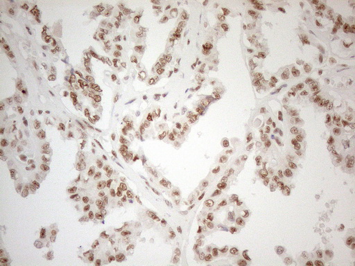 WTAP Antibody - Immunohistochemical staining of paraffin-embedded Carcinoma of Human thyroid tissue using anti-WTAP mouse monoclonal antibody. (Heat-induced epitope retrieval by 1mM EDTA in 10mM Tris buffer. (pH8.5) at 120°C for 3 min. (1:150)