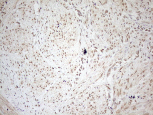 WTAP Antibody - Immunohistochemical staining of paraffin-embedded Human endometrium tissue using anti-WTAP mouse monoclonal antibody. (Heat-induced epitope retrieval by 1mM EDTA in 10mM Tris buffer. (pH8.5) at 120°C for 3 min. (1:150)