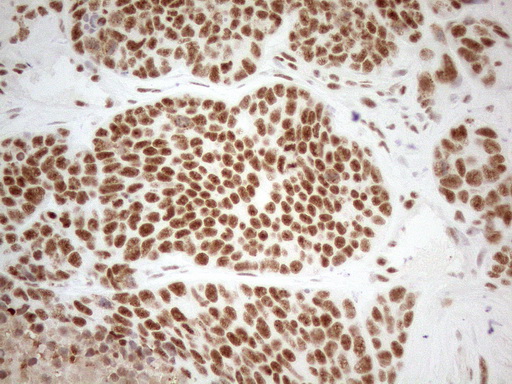 WTAP Antibody - Immunohistochemical staining of paraffin-embedded Adenocarcinoma of Human endometrium tissue using anti-WTAP mouse monoclonal antibody. (Heat-induced epitope retrieval by 1mM EDTA in 10mM Tris buffer. (pH8.5) at 120°C for 3 min. (1:150)