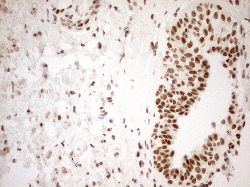 WTAP Antibody - Immunohistochemical staining of paraffin-embedded Carcinoma of Human prostate tissue using anti-WTAP mouse monoclonal antibody. (Heat-induced epitope retrieval by 1mM EDTA in 10mM Tris buffer. (pH8.5) at 120°C for 3 min. (1:150)