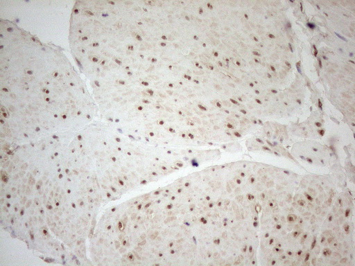 WTAP Antibody - Immunohistochemical staining of paraffin-embedded Human bladder tissue using anti-WTAP mouse monoclonal antibody. (Heat-induced epitope retrieval by 1mM EDTA in 10mM Tris buffer. (pH8.5) at 120°C for 3 min. (1:150)