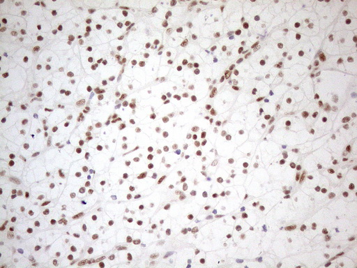 WTAP Antibody - Immunohistochemical staining of paraffin-embedded Carcinoma of Human kidney tissue using anti-WTAP mouse monoclonal antibody. (Heat-induced epitope retrieval by 1mM EDTA in 10mM Tris buffer. (pH8.5) at 120°C for 3 min. (1:150)
