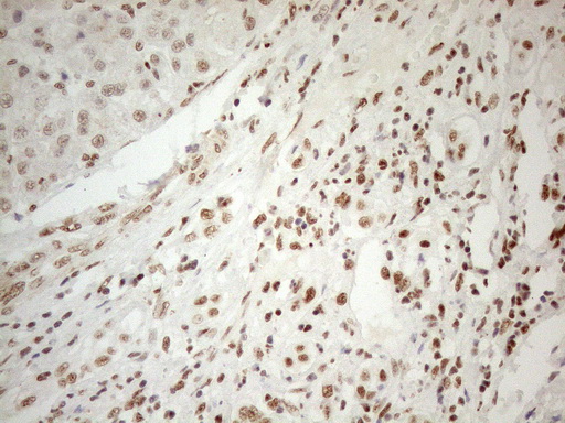 WTAP Antibody - Immunohistochemical staining of paraffin-embedded Carcinoma of Human liver tissue using anti-WTAP mouse monoclonal antibody. (Heat-induced epitope retrieval by 1mM EDTA in 10mM Tris buffer. (pH8.5) at 120°C for 3 min. (1:150)