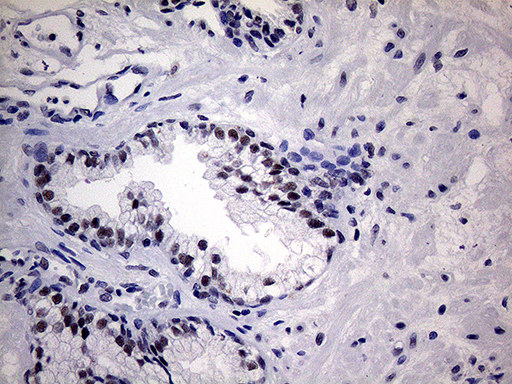 WTAP Antibody - Immunohistochemical staining of paraffin-embedded Carcinoma of Human prostate tissue using anti-WTAP mouse monoclonal antibody. (Heat-induced epitope retrieval by 1mM EDTA in 10mM Tris buffer. (pH8.5) at 120°C for 3 min. (1:2000)