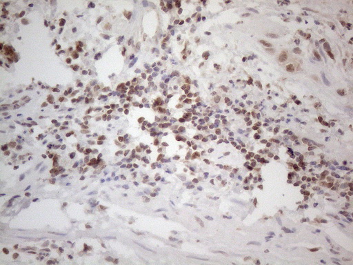 WTAP Antibody - Immunohistochemical staining of paraffin-embedded Carcinoma of Human bladder tissue using anti-WTAP mouse monoclonal antibody. (Heat-induced epitope retrieval by 1mM EDTA in 10mM Tris buffer. (pH8.5) at 120°C for 3 min. (1:150)