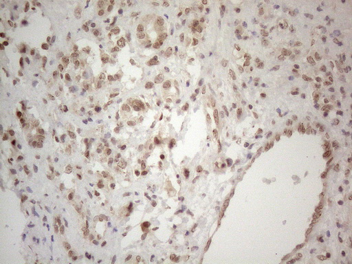 WTAP Antibody - Immunohistochemical staining of paraffin-embedded Carcinoma of Human liver tissue using anti-WTAP mouse monoclonal antibody. (Heat-induced epitope retrieval by 1mM EDTA in 10mM Tris buffer. (pH8.5) at 120°C for 3 min. (1:150)