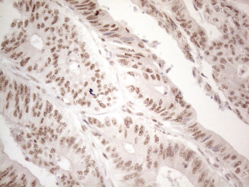 WTAP Antibody - Immunohistochemical staining of paraffin-embedded Adenocarcinoma of Human colon tissue using anti-WTAP mouse monoclonal antibody. (Heat-induced epitope retrieval by 1mM EDTA in 10mM Tris buffer. (pH8.5) at 120°C for 3 min. (1:150)