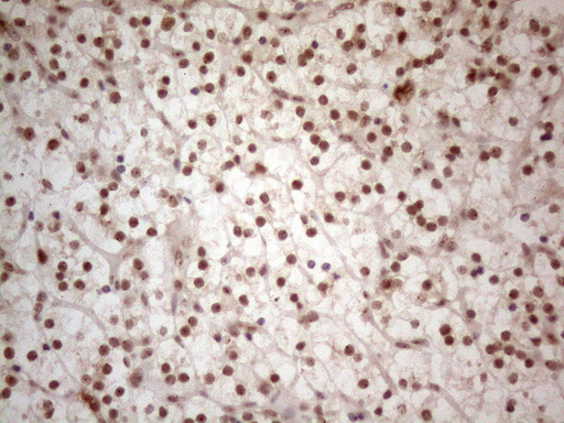 WTAP Antibody - Immunohistochemical staining of paraffin-embedded Carcinoma of Human kidney tissue using anti-WTAP mouse monoclonal antibody. (Heat-induced epitope retrieval by 1mM EDTA in 10mM Tris buffer. (pH8.5) at 120°C for 3 min. (1:150)