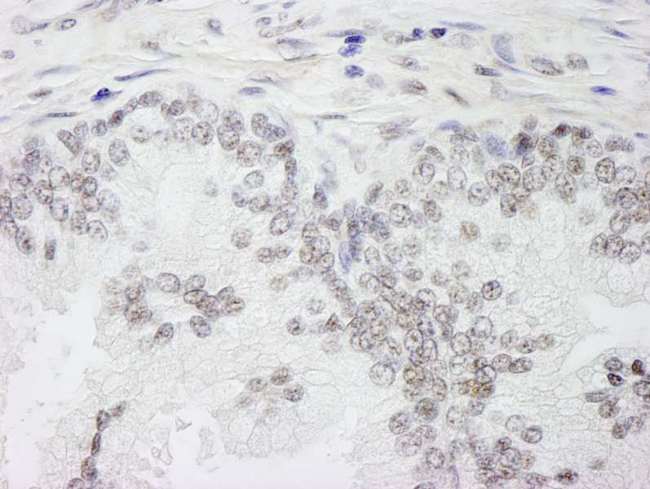WTAP Antibody - Detection of Human WTAP by Immunohistochemistry. Sample: FFPE section of human prostate carcinoma. Antibody: Affinity purified rabbit anti-WTAP used at a dilution of 1:250.