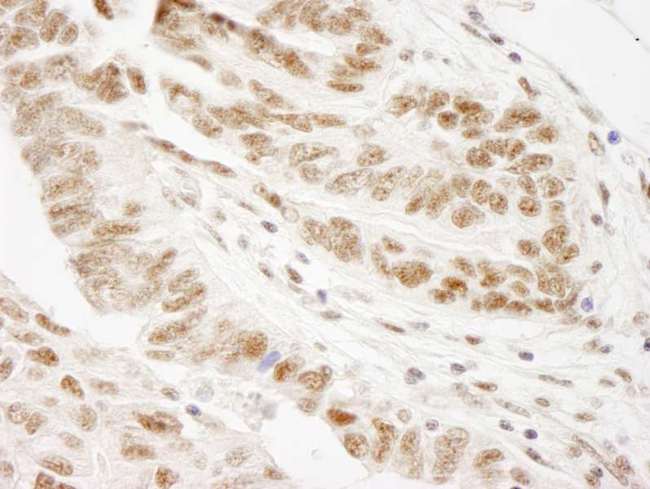 WTAP Antibody - Detection of Human WTAP by Immunohistochemistry. Sample: FFPE section of human ovarian carcinoma. Antibody: Affinity purified rabbit anti-WTAP used at a dilution of 1:250.