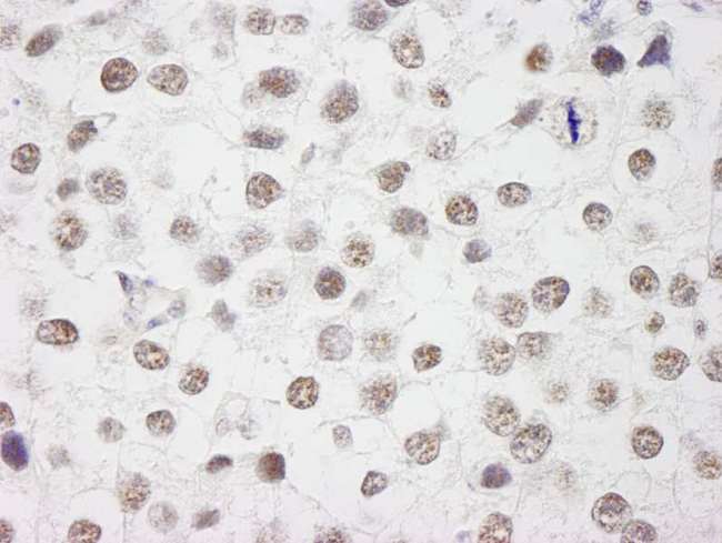 WTAP Antibody - Detection of Human WTAP by Immunohistochemistry. Sample: FFPE section of human testicular seminoma. Antibody: Affinity purified rabbit anti-WTAP used at a dilution of 1:1000 (1 ug/ml). Detection: DAB.