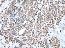 WTAP Antibody - Immunohistochemistry of paraffin-embedded Human thyroid cancer tissue  using WTAP Polyclonal Antibody at dilution of 1:35(×200)