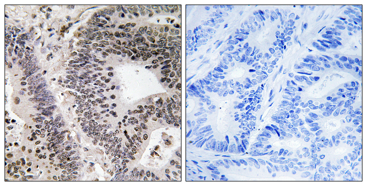 WWOX Antibody - Immunohistochemistry analysis of paraffin-embedded human colon carcinoma, using WWOX (Phospho-Tyr33) Antibody. The picture on the right is blocked with the phospho peptide.