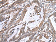 WWP1 Antibody - Immunohistochemistry of paraffin-embedded Human esophagus cancer tissue  using WWP1 Polyclonal Antibody at dilution of 1:40(×200)