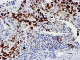 WWTR1 / TAZ Antibody - IHC of paraffin-embedded Carcinoma of Human lung tissue using anti-WWTR1 mouse monoclonal antibody.
