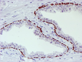 WWTR1 / TAZ Antibody - IHC of paraffin-embedded Carcinoma of Human prostate tissue using anti-WWTR1 mouse monoclonal antibody.