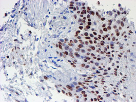 WWTR1 / TAZ Antibody - IHC of paraffin-embedded Carcinoma of Human bladder tissue using anti-WWTR1 mouse monoclonal antibody.