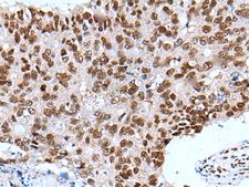 XAB2 Antibody - Immunohistochemistry of paraffin-embedded Human colorectal cancer tissue  using XAB2 Polyclonal Antibody at dilution of 1:25(×200)