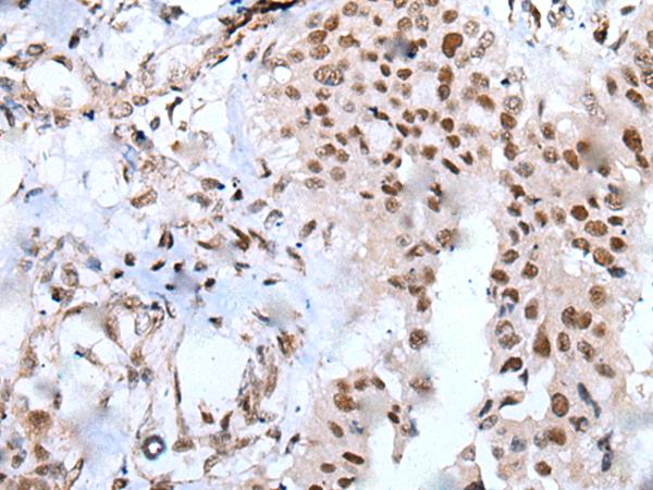 XAB2 Antibody - Immunohistochemistry of paraffin-embedded Human liver cancer tissue  using XAB2 Polyclonal Antibody at dilution of 1:25(×200)