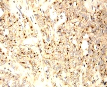 XAF1 Antibody - IHC-P: XAF1 antibody testing of human endometrial carcinoma tissue
