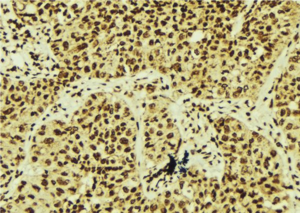 XBP1 Antibody - 1:100 staining human breast carcinoma tissue by IHC-P. The sample was formaldehyde fixed and a heat mediated antigen retrieval step in citrate buffer was performed. The sample was then blocked and incubated with the antibody for 1.5 hours at 22°C. An HRP conjugated goat anti-rabbit antibody was used as the secondary.