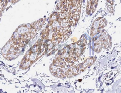 XBP1 Antibody - 1/100 staining human breast carcinoma tissue by IHC-P. The sample was formaldehyde fixed and a heat mediated antigen retrieval step in citrate buffer was performed. The sample was then blocked and incubated with the antibody for 1.5 hours at 22°C. An HRP conjugated goat anti-rabbit antibody was used as the secondary antibody.