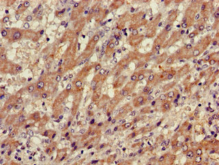 XBP1 Antibody - Immunohistochemistry of paraffin-embedded human liver cancer using XBP1 Antibody at dilution of 1:100