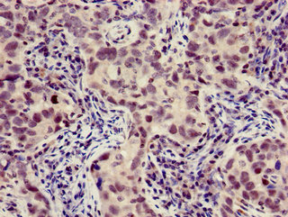 XBP1 Antibody - Immunohistochemistry of paraffin-embedded human pancreatic cancer using XBP1 Antibody at dilution of 1:100