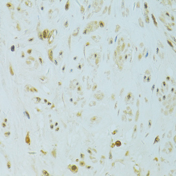 XBP1 Antibody - Immunohistochemistry of paraffin-embedded human uterine cancer using XBP1 antibody at dilution of 1:100 (40x lens).