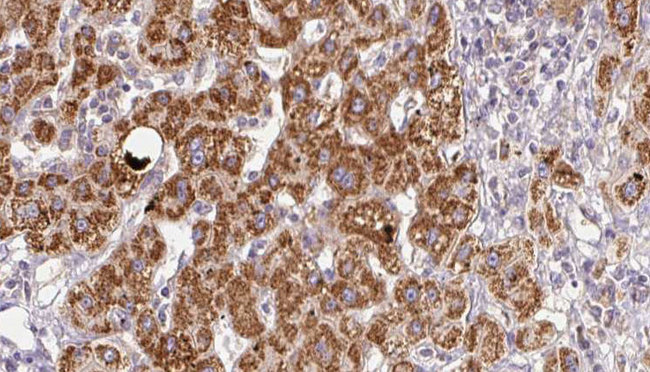 XCR1 Antibody - 1:100 staining human liver carcinoma tissues by IHC-P. The sample was formaldehyde fixed and a heat mediated antigen retrieval step in citrate buffer was performed. The sample was then blocked and incubated with the antibody for 1.5 hours at 22°C. An HRP conjugated goat anti-rabbit antibody was used as the secondary.