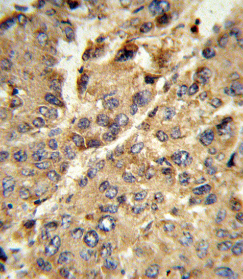 XDH / Xanthine Oxidase Antibody - Formalin-fixed and paraffin-embedded human hepatocarcinoma reacted with XDH Antibody , which was peroxidase-conjugated to the secondary antibody, followed by DAB staining. This data demonstrates the use of this antibody for immunohistochemistry; clinical relevance has not been evaluated.