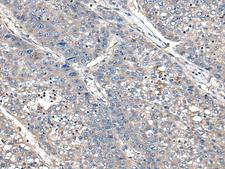 XDH / Xanthine Oxidase Antibody - Immunohistochemistry of paraffin-embedded Human liver cancer tissue  using XDH Polyclonal Antibody at dilution of 1:85(×200)