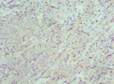 XIAP Antibody - Immunohistochemistry of paraffin-embedded human rectal cancer using antibody at 1:100 dilution.