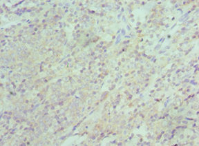 XIAP Antibody - Immunohistochemistry of paraffin-embedded human colon cancer using XIAP Antibody at dilution of 1:100