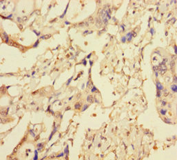 XIAP Antibody - Immunohistochemistry of paraffin-embedded human pancreatic cancer using XIAP Antibody at dilution of 1:100