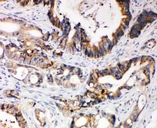 XIAP Antibody - XIAP antibody. IHC(P): Human Intestinal Cancer Tissue.