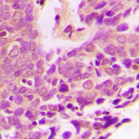 XIAP Antibody - Immunohistochemical analysis of XIAP staining in human breast cancer formalin fixed paraffin embedded tissue section. The section was pre-treated using heat mediated antigen retrieval with sodium citrate buffer (pH 6.0). The section was then incubated with the antibody at room temperature and detected using an HRP-conjugated compact polymer system. DAB was used as the chromogen. The section was then counterstained with hematoxylin and mounted with DPX.