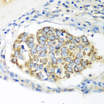 XIAP Antibody - Immunohistochemistry of paraffin-embedded human lung cancer tissue.