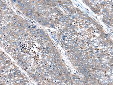 XIRP1 Antibody - Immunohistochemistry of paraffin-embedded Human liver cancer tissue  using XIRP1 Polyclonal Antibody at dilution of 1:90(×200)