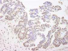 XPA Antibody - Detection of Human XPA by Immunohistochemistry. Sample: FFPE section of human ovarian tumor. Antibody: Affinity purified rabbit anti-XPA used at a dilution of 1:500.