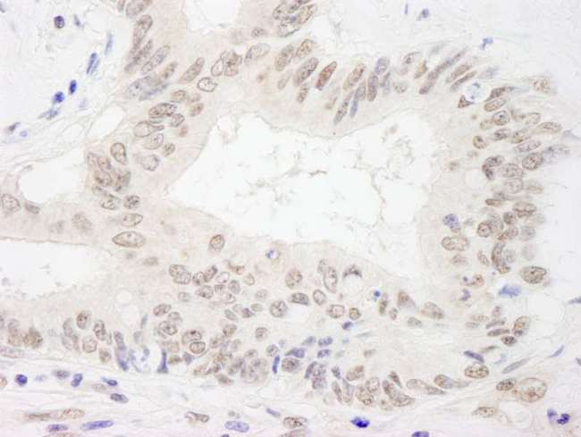 XPA Antibody - Detection of Human XPA by Immunohistochemistry. Sample: FFPE section of human colon carcinoma. Antibody: Affinity purified rabbit anti-XPA used at a dilution of 1:500.