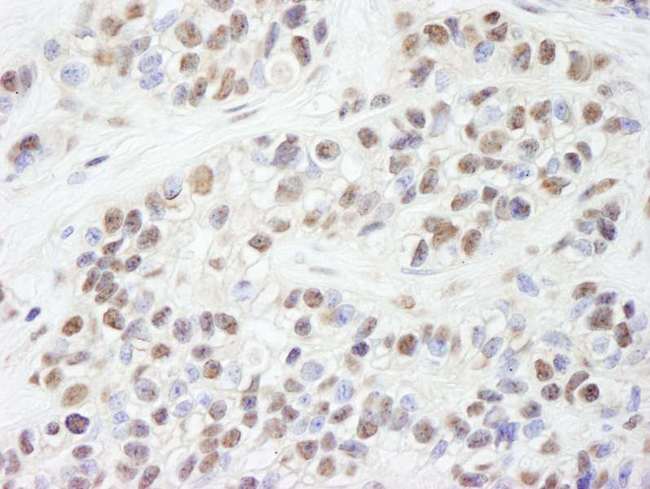 XPA Antibody - Detection of Human XPA by Immunohistochemistry. Sample: FFPE section of human breast carcinoma. Antibody: Affinity purified rabbit anti-XPA used at a dilution of 1:1000 (0.2 ug/ml). Detection: DAB.
