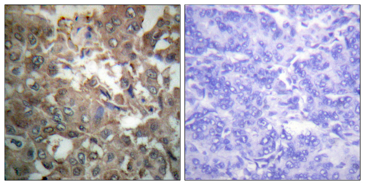 XPA Antibody - Immunohistochemistry analysis of paraffin-embedded human breast carcinoma tissue, using XPA Antibody. The picture on the right is blocked with the synthesized peptide.